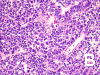 FNA0IE02-Medulloepithelioma-A2.gif (133107 bytes)