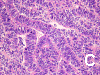 FNA0IE02-Medulloepithelioma-A4.gif (143117 bytes)