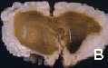 FNA0IE04-Medullo-B1.gif (73441 bytes)