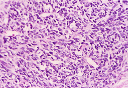 DIAGNOSIS: Extraskeletalmesenchymal chondrosarcoma.