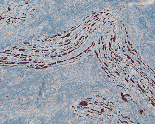 A 4 Year Old Girl With A Rapidly Expanding Cervical Intradural Extramedullary Mass September 04 Case 409 2 Home Page Michael Martin M D 1 Kalliopi Petropoulou M D 2 Chimene Kesserwan M D 3 Kar Ming Fung M D Ph D 2 Last Update