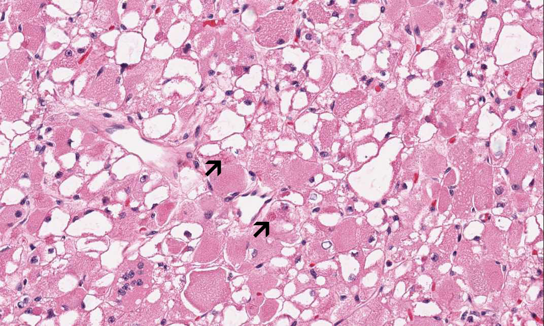 Results of immunohistochemistry and special stain are as follow: