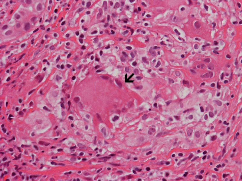 Hematoxylin & eosin