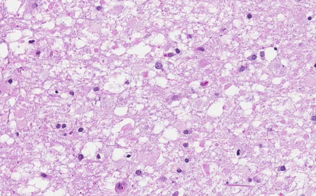 Hematoxylin & eosin