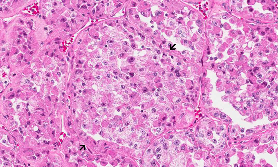 Hematoxylin & eosin