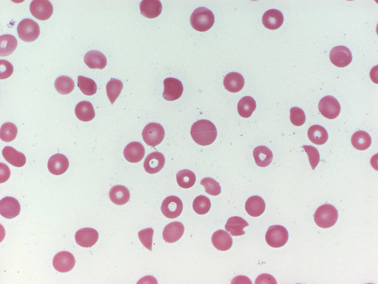 microscopic view of blood cells from a patient with TTP